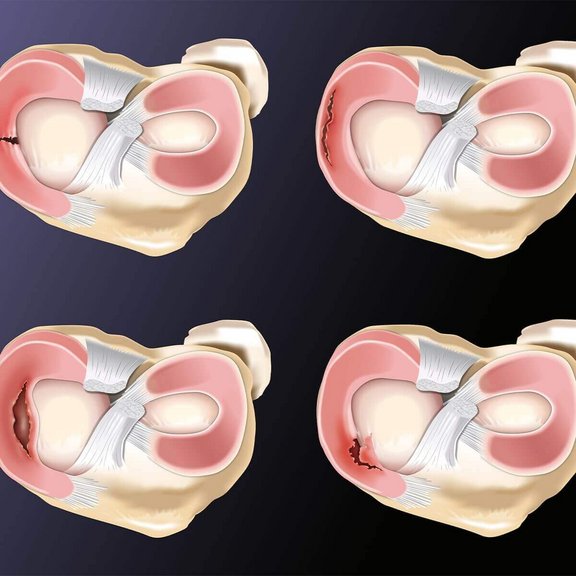 Ortho-Energy-Meniskusverletzung-2.jpg