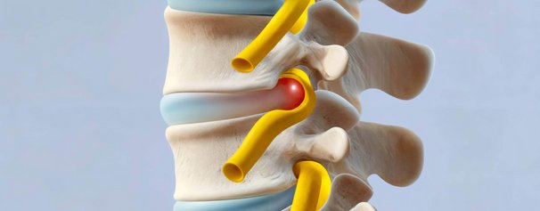 Ortho-Energy-Headerbild-Bandschiebenvorfall.jpg 